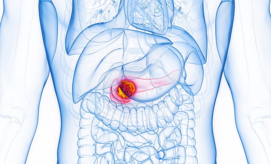 아주대-서울대 공동 연구팀,  췌장암 환자·모델 조직의 불일치 현상 규명